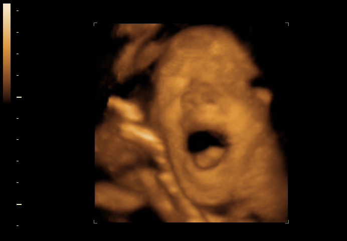 3D ultrasound image at 30 weeks
